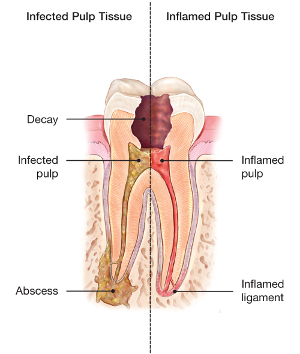 abcessed tooth