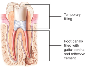 root canal filling